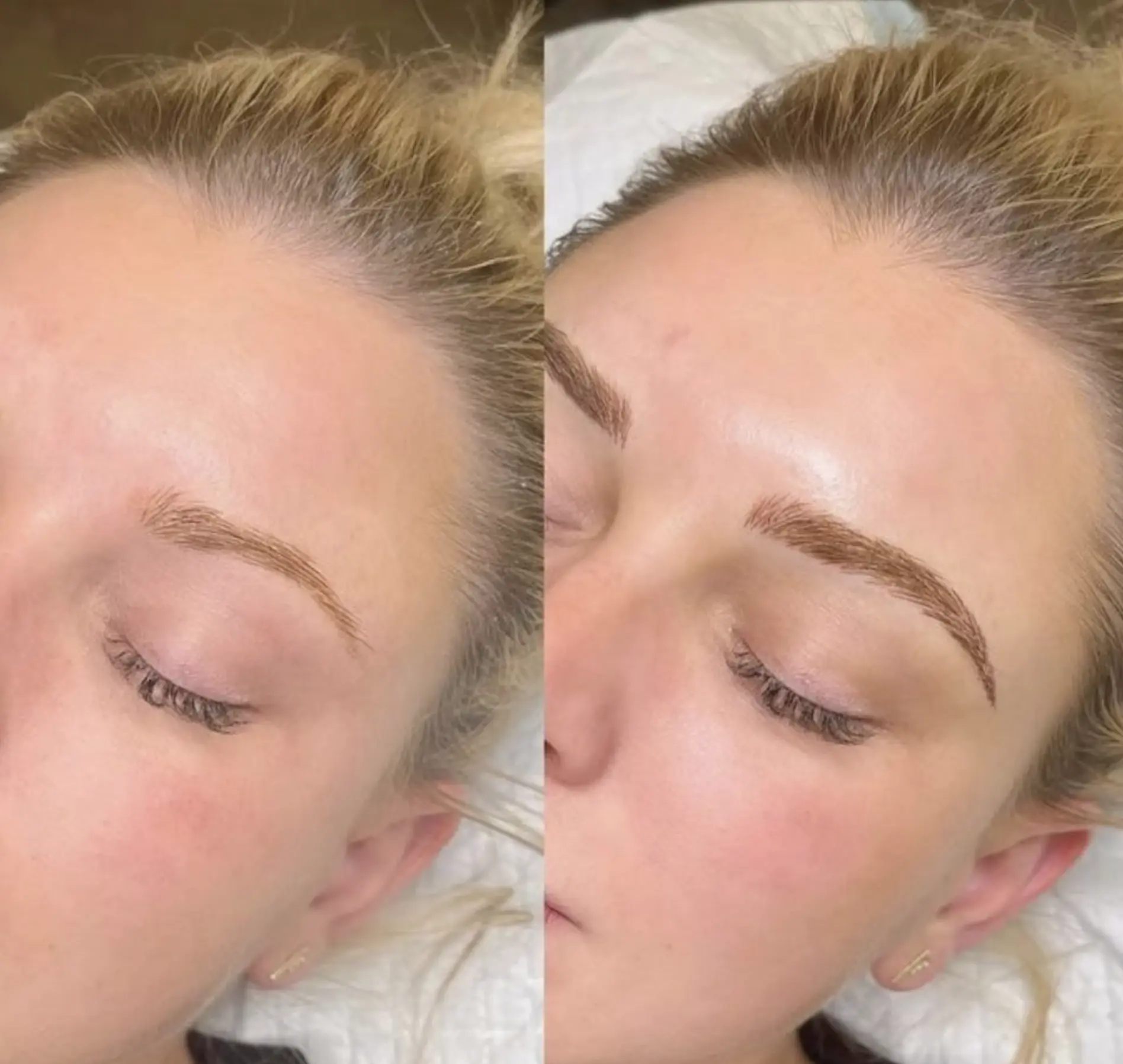 eyebrow tattoo laser removal